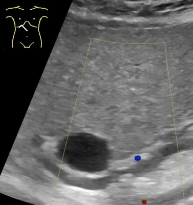 Illustration: Gallstone Abdominal Pain: Symptoms and Patterns
