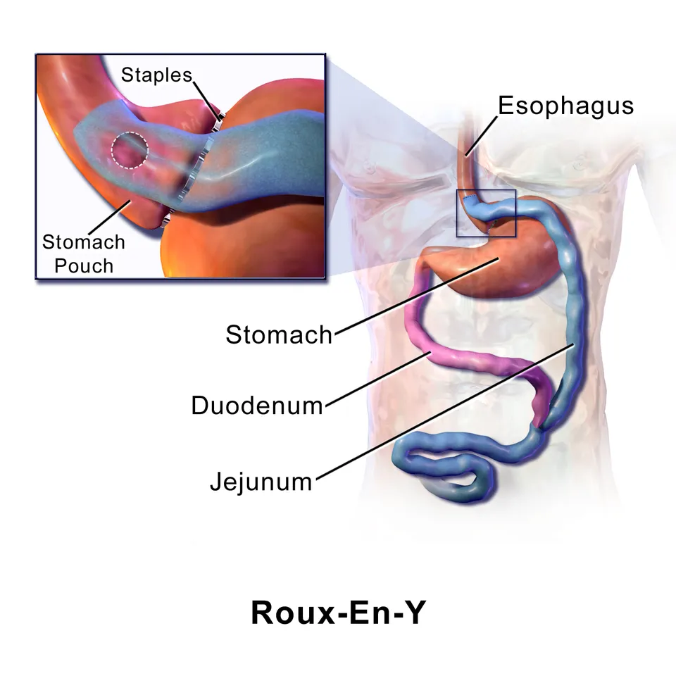 Illustration: How Does the Roux-en-Y Gastric Bypass Work in 2026?