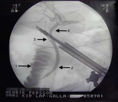 Illustration: How to Identify Normal vs. Abnormal Digestion After Cholecystectomy?