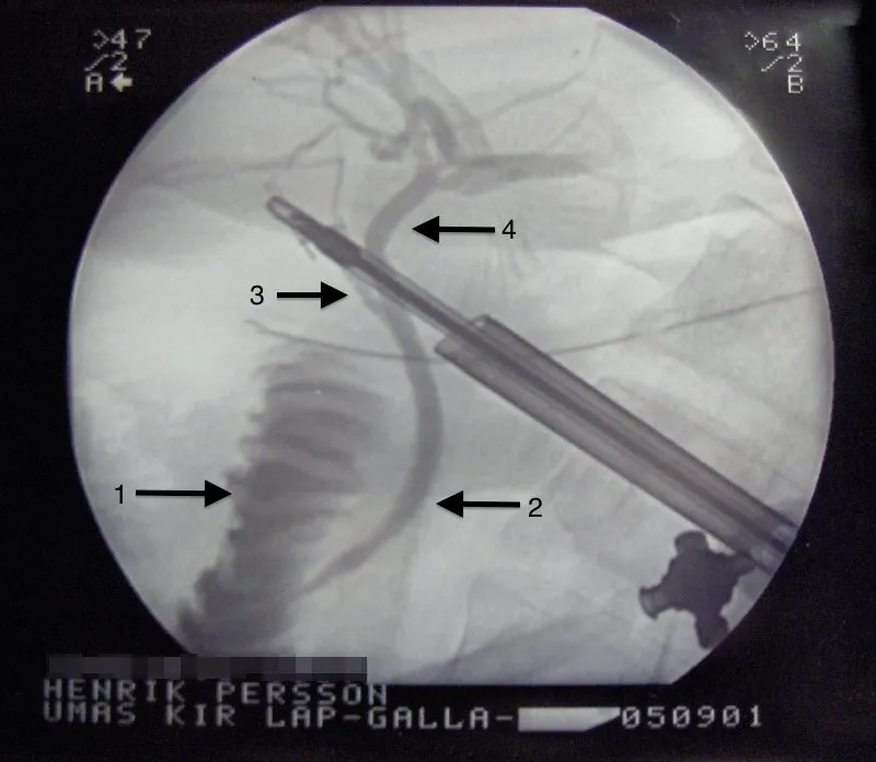 Illustration: How to Identify Normal vs. Abnormal Digestion After Cholecystectomy?